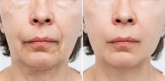 Restoring Saggy Facial Skin